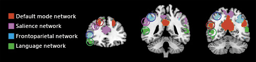 Fig. 3. Non-overlapping hubs for the major cognitive networks (language, frontoparietal, salience, and default mode networks). Maps were extracted through independent component analysis from a sample of 20 healthy subjects and overlaid into the MNI template. Circles highlight the spatial localization of non-convergent dorsal frontal and parietal hubs of each functional network.