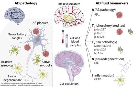 AD pathology and associated fluid (CSF and plasma) biomarkers. Aβ, amyloid-β; AD, Alzheimer’s disease; CSF, cerebrospinal fluid; GFAP, glial fibrillary acidic protein; MTBR-tau, microtubule-binding region tau; NfL, neurofilament light; NTA-tau, N-terminal-associated tau; p-tau, phosphorylated tau.