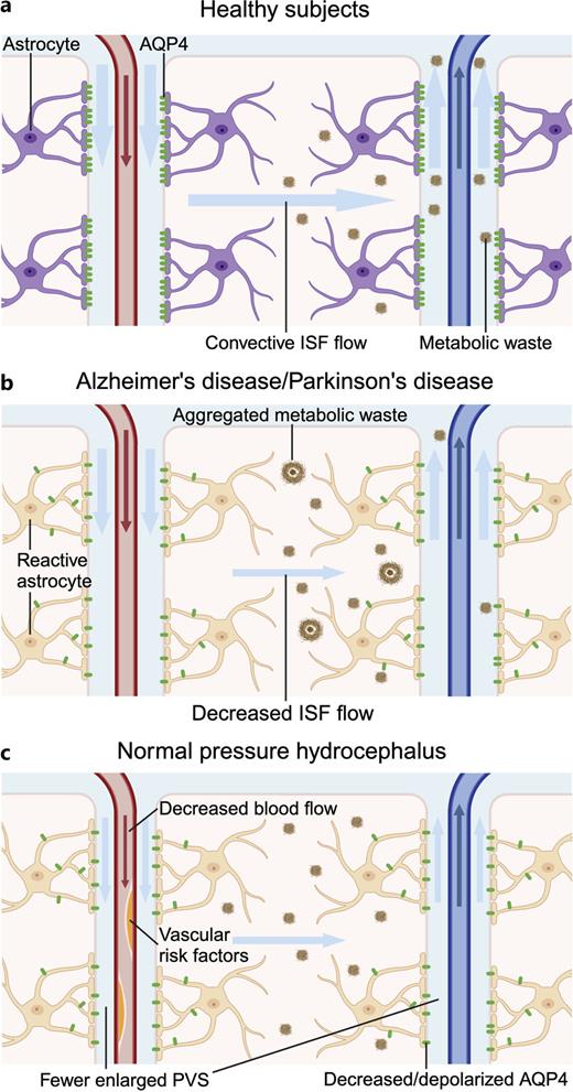 a Glymphatic dysfunction underlying accumulation of pathogenic protein and development of hydrocephalus. Normal glymphatic system in healthy subjects. b Glymphatic dysfunction leads to the accumulation of pathogenic proteins such as β-amyloid, tau, and α-synuclein. c Altered expression and the loss of polarization of AQP4 may lead to glymphatic dysfunction and CSF accumulation in the ventricles. These mechanisms underlie the pathogenesis of iNPH and possibly NPH secondary to some neurodegenerative diseases. The decreased cerebral blood flow [42], fewer enlarged PVS in the centrum semiovale [43], and vascular risk factors [44] were observed in patients with iNPH. CSF, cerebrospinal fluid; ISF, interstitial fluid; AQP4, aquaporin-4; NPH, normal pressure hydrocephalus; PVS, perivascular space. Created with BioRender.com.