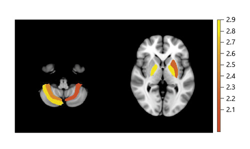 Fig. 2. T map of significant (p < 0.05) volume differences in individual ROIs derived from the Harvard-Oxford Cortical and Subcortical Atlases and Probabilistic Cerebellar Atlas. Cortical and subcortical atlases are shown on the right and cerebral atlas on the left. The color graph on the right indicates the difference in volume in cm3 with yellow indicating a larger difference. The highlighted subcortical structures include the left putamen and bilateral pallidum. ROIs, regions of interest.