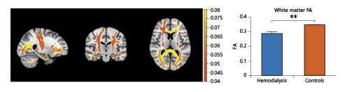 Fig. 3. Map of significant FA differences in tracts identified using tractography and whole white matter difference in FA between the groups. On the left are the FA differences in tracts using tractography, and tROIs were summed and mapped as the FA difference between the 2 groups. Highlighted tracts all have statistically significant differences compared to controls with p < 0.01. The degree of differences in FA is shown with the color graph, with yellow indicating a higher difference. On the right is the difference in whole white matter FA between the groups, with p < 0.01. HD, hemodialysis; FA, fractional anisotropy; tROIs, tract regions of interest.