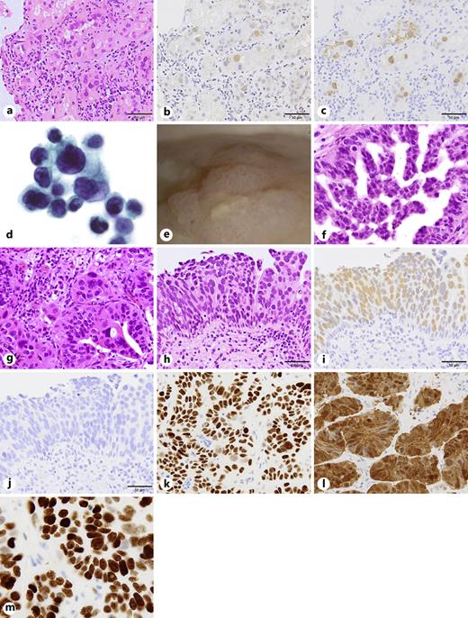 BK Polyomavirus-Associated Urothelial Carcinoma of the Bladder with a ...