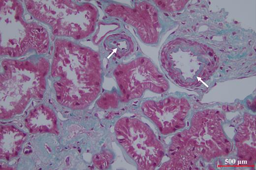 Stenosis of the small arteries and thickening of the intima.
