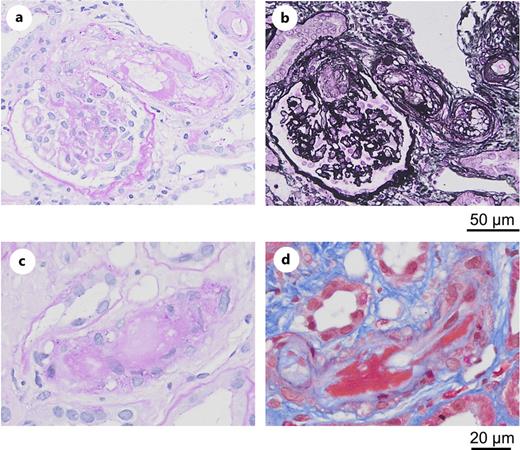 Light microscopic findings. a The afferent arteriole showed endothelial cell swelling and proliferation, foam cell infiltration, and degeneration and necrosis of smooth muscle cells (periodic acid-Schiff stain). b Thrombus formation was observed at the vascular pole of the glomeruli, and the glomeruli showed ischemic capillary loop wrinkling (periodic acid methenamine silver stain). c The arteriole showed degeneration and necrosis of smooth muscle cells, with hyaline deposits replacing the degenerated smooth muscle cells (periodic acid-Schiff stain). d The lumen of the arteriole was occluded by fibrin thrombi (elastica-Masson stain).