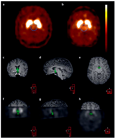 Fig. 1. Example of SERT binding. a, b Transverse SERT binding in the diencephalon of a lean (a) and IRO (b) subject. c-e ROI manually drawn on an individual coronal (c), sagittal (d), and transverse (e) MRI for assessment of hypothalamic SERT binding. f-h Coronal (f), sagittal (g), and transverse (h) co-registered SPECT and MRI image showing manually drawn ROI (hypothalamus).