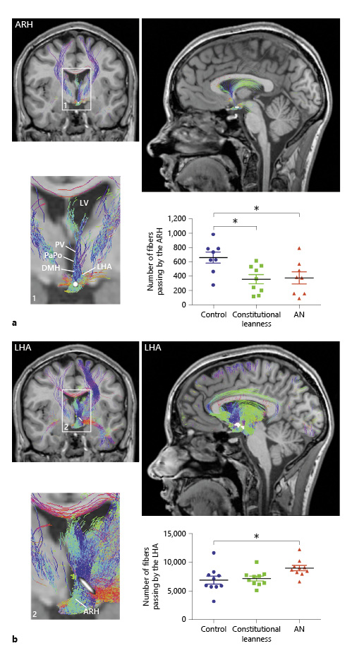 Hypothalamic Structural and Functional Imbalances in Anorexia Nervosa ...