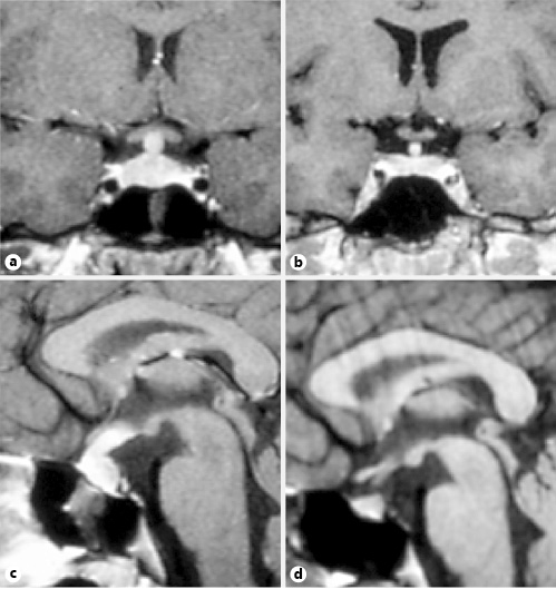 Pituitary Stalk Enlargement in Adults | Neuroendocrinology | Karger ...