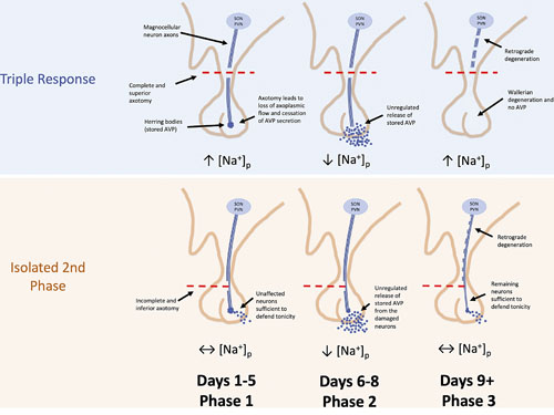 Isolated second phase as a cause of delayed hyponatremia after pituitary surgery. Interruption of axoplasmic flow in magnocellular neurons by stalk lesioning leads to DI. In the following days, AVP stored in terminal Herring bodies is released from degenerating neurons, causing a transient SIADH-like state. These AVP stores are soon exhausted and chronic DI ensues. In cases where the initial insult is less severe, the quantity of spared neurons is sufficient to defend tonicity, but unregulated release of stored AVP still occurs in damaged neurons, and a delayed, isolated period of hyponatremia ensues (isolated second phase). Reprinted by permission from the Copyright Clearance Center: Springer Nature, Neurosurgical Review, Hyponatraemia and hypernatraemiahypernatremia: disorders of water balance in neurosurgery, Castle-Kirszbaum M, Kyi M, Wright C, Goldschlager T, Danks RA, Parkin G, 2021 Springer Nature Switzerland AG. AVP, arginine vasopressin; DI, diabetes insipidus; PVN, paraventricular nucleus; SIADH, syndrome of inappropriate antidiuresis; SON, supraoptic nucleus.