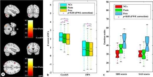 Two informative functional brain networks as well as emotion scales with significant longitudinal changes in CD patients before treatment and at the 3-month follow-up. a Brain regions with significant longitudinal changes in functional connectivity within circuits of CerebN and FPN for CD patients, identified using non-parametric permutation tests (AlphaSim-corrected p < 0.01). b, c Significantly different functional connectivity measured by IC’s z scores across voxels within circuits of CerebN and FPN as well as emotion scales measured by the self-rating depression scale (SDS) and self-rating anxiety scale (SAS) between any two of NCs, CD patients before the treatment (i.e., active CD patients), and endocrine-remitted CD patients at 3-month follow-up (FDR-corrected p < 0.05). A pseudo paired t test with age, sex, and years of school education as covariates was conducted to compare all IC’s z scores within each functional network as well as the SDS scores and SAS scores between CD patients before treatment and at the 3-month follow-up. While a pseudo two-sample t test with age, sex, and years of school education as covariates was conducted to compare IC’s z scores within each functional network as well as SDS scores and SAS scores between NCs and CD patients before treatment, and endocrine-remitted CD patients at 3-month follow-up. CerebN, cerebellar network; FPN, fronto-parietal network; CD, Cushing’s disease; Pres, CD patients before treatment; Posts, endocrine-remitted CD patients at 3-month follow-up; NCs, normal controls; ICs, independent components; FDR, false discovery rate.