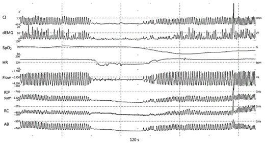 Fig. 1. Example of respiratory tracings of dEMG, CI, and RIP combined with SpO2, HR, and flow for an apnea classified as central. CI, chest impedance; dEMG, diaphragmatic EMG; SpO2, oxygen saturation; HR, heart rate; RIP sum, summed rib-cage and abdominal signal of RIP; RC, rib cage signal of RIP; AB, abdominal signal of RIP; µV, microvolt; bpm, beats per minute; mL, millilitre; Cnts, counts.