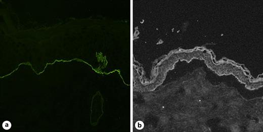 Immunofluorescence. a Direct immunofluorescence on the skin biopsy showing linear deposits of IgA along basement membrane zone at the derma-epidermal junction. b Split-skin indirect immunofluorescence of the mother’s breastmilk.