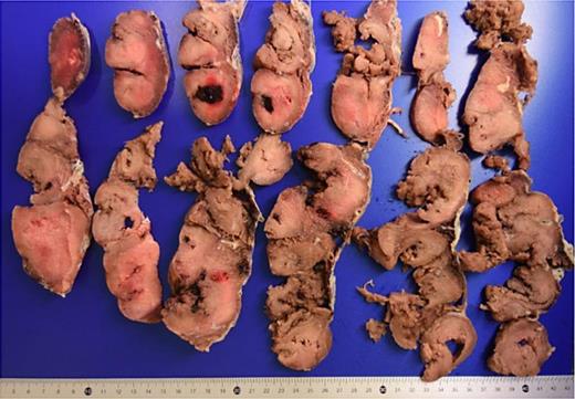 Large placenta (20 × 19 cm) with increased thickness (5 cm) and a homogenous, pale parenchyma.