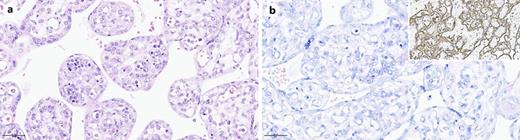 a Hematoxylin-eosin staining (×400): severe fetal erythroblastosis with a maturation spectrum and clusters of proerythroblasts; no evidence of parvovirus B19 inclusions. b Giemsa staining (×400): proerythroblasts with macro- and megaloblastic features within villous capillaries. Inset: CD71 underlines the numerous erythroid precursors within the fetal placental circulation.