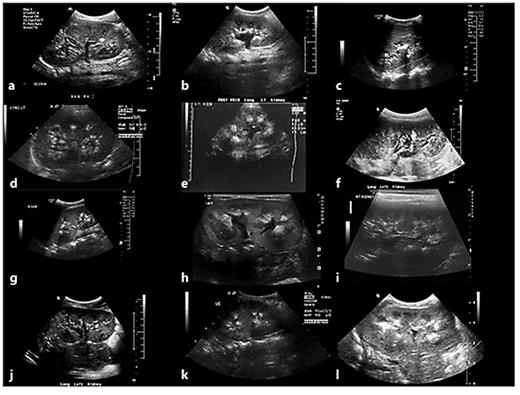 Fig. 1. Representative ultrasound images detailing nephrocalcinosis. Shown are ultrasound images of kidneys from patient 1, right kidney, age 10 years (a), patient 3, age 16 years (b), patient 4, left kidney, age 24 years (c), patient 8, left kidney, age 12 years (d), patient 5, age 9 months (e), patient 9, left kidney, age 14 years (f), patient 10, right kidney, age 17 years (g), patient 12, left kidney, age 6 months (h), patient 13, right kidney, age 8 years (I), patient 14, left kidney, age 13 years (j), patient 15, left kidney, age 13 years (k), and patient 16, left kidney, age 3 months (l). Note the varying pattern of nephrocalcinosis by ultrasound, ranging from isolated echodensities to a generalized punctuate pattern to medullary nephrocalcinosis.