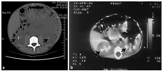 Fig. 2. Representative CT images detailing nephrocalcinosis. Shown are abdominal CT images from patient 4, age 24 years (a) and patient 5, age 9 months (b). Note the calcium densities in the kidneys (arrows).