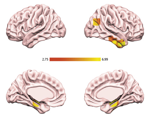  Increased connectivity of the left precuneus with the right hippocampus significantly correlated with higher SPS scores. SPS, sensory processing sensitivity.