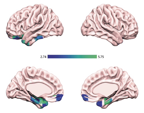  Negative connectivity of the right PAG and left amygdala/hippocampus significantly correlated with higher SPS scores. SPS, sensory processing sensitivity; PAG, periaqueductal gray.