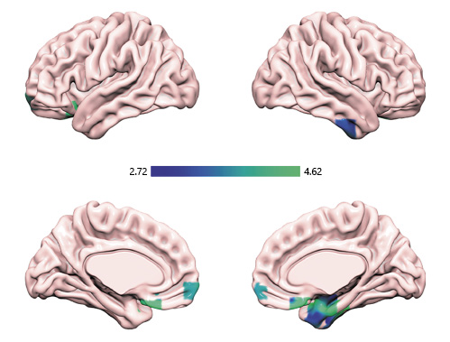  Negative connectivity of the right insula and right hippocampus significantly correlated with higher SPS scores. SPS, sensory processing sensitivity.