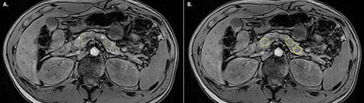 Fig. 1. Measurements of pancreas diameters (A) and intra-pancreatic fat deposition (B) in a 30-year-old healthy woman with a body mass index of 20.0 kg/m2. Out-of-phase images are presented. Regions of interest were placed in the head, body, and tail of the pancreas. The anteroposterior diameter of the pancreas head was measured in line with the right-most point of the confluence of the superior mesenteric and splenic veins (a); the anteroposterior diameter of the pancreas body was measured in line with the left lateral border of the lumbar vertebrae (b); the tail diameter of the pancreas was measured as a line perpendicular to the organ midline, at a point 20 mm from the distal-most point of the pancreas in the slice (c).