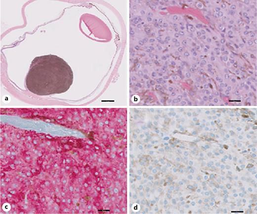 Fig. 2. UM with negative PRAME IHC expression (case 17). a Cross-section of enucleation shows choroidal melanoma tumor toward the posterior pole (H&amp;E stain). b High-power image of the malignant melanoma cells in the tumor (H&amp;E stain). c MART-1 immunolabeling (red cytosolic staining) highlights melanoma cells. d PRAME immunolabeling (brown nuclear staining) is negative. Nuclei in b–d have been counterstained with hematoxylin (blue). Scale bars, 2 mm (a) and 20 μm (b–d).