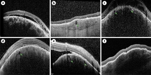 Various optical coherence tomography (OCT) findings of choroidal hemangiomas noted. a The classic smooth choroidal elevation with enlarged large choroidal vessels. b–e Choroidal cavitations (green arrows) that are very hypo-reflective and relatively close to the surface of the lesions. Several cases demonstrated a lumpier, non-smooth, surface as exemplified in (f).