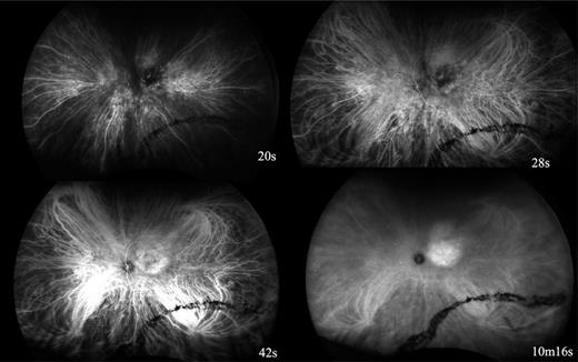Every case was confirmed by indocyanine green angiography (ICG) to have a pattern compatible with a diagnosis of choroidal hemangioma. In this exemplary case, four frames from the injection of the dye into the antecubital vein are displayed with the time indicated in the bottom right corner of each image. In the early phases, there is arterial flow into the choroidal hemangiomas with late pooling of cyanescens into a circumscribed space that tends to increase in intensity as the choroidal vascular cyanescens fades elsewhere in the later frames. Note artifact from prior laser inferotemporally that is unrelated to the hemangioma.