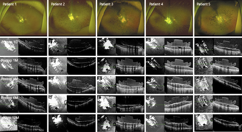 Postoperative fundus photographs and OCT images of the patients. In all of the eyes, the microelectrode array was well positioned over the macula. OCT revealed the development of fibrosis-like hyperreflective tissues at the interface between the array and the retina in 3 eyes (first seen in patient 1 at 12 postoperative months and in patients 3 and 4 at 3 postoperative months).