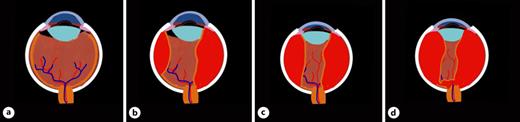 Suprachoroidal Hemorrhage | Ophthalmologica | Karger Publishers