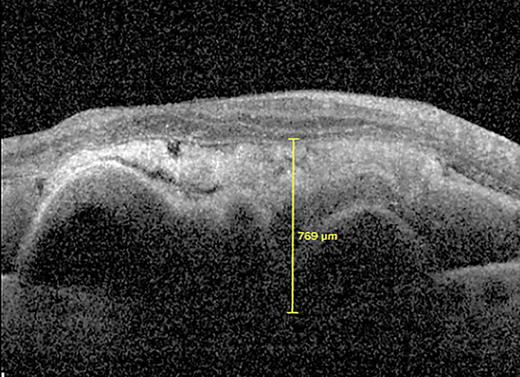 Current Management of Subretinal Hemorrhage in Neovascular Age-Related ...