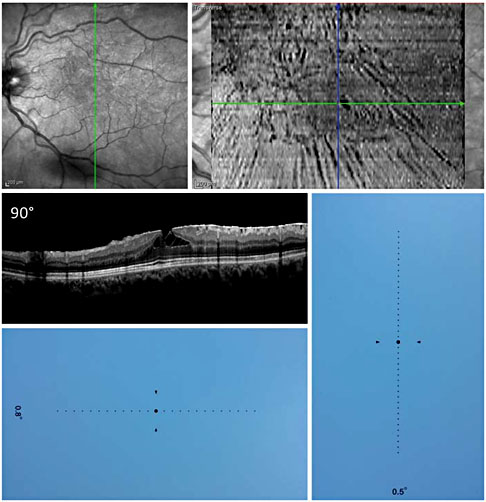 Metamorphopsia: An Overlooked Visual Symptom | Ophthalmic Research ...