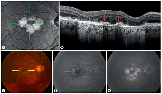 Geographic Atrophy and Choroidal Neovascularization in the Same Eye: A ...