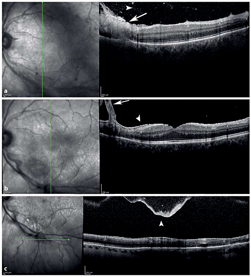 Fig. 5. SD-OCT of a Toxoplasma chorioretinits lesion. a Vertical SD-OCT through the retinal lesion shows retinal thickening with full-thickness retinal hyperreflectivity (white arrow) extending down to the level of the retinal pigment epithelium and Bruch's membrane. Hyperreflective spots in the vitreous (white arrowhead) in the acute phase demonstrate posterior vitreous cell. b Thickening of the posterior hyaloid (white arrow) over the scar and epiretinal membrane formation (white arrowhead) in the chronic phase. c Thickened posterior hyaloid face and a posterior vitreous detachment (white arrowhead) over the lesion in the chronic phase.