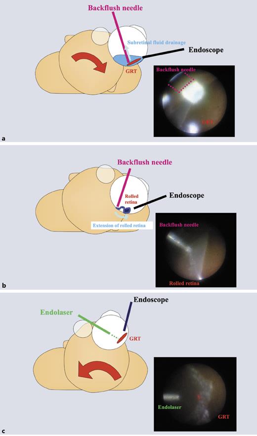 Fig. 1. Schematic images of endoscope-assisted vitreous surgery for GRT detachment. a First, the patient’s head was moved toward the position where the GRT was located, at the lowest level. In this position, subretinal fluid can easily flow from the retinal break into the vitreous space. We inserted the backflush needle with a silicone tip from the higher positioned port and the ophthalmic endoscopic probe from the lower positioned port. b Then, the rolled retina was unfolded using a backflush needle, under air. c Finally, the patient’s head was returned to the original position, and endolaser photocoagulation was performed around the primary retinal break, under air. GRT, giant retinal tear.