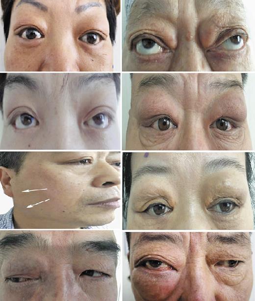 Fig. 1. Clinical features and manifestations of IgG4-ROD patients.