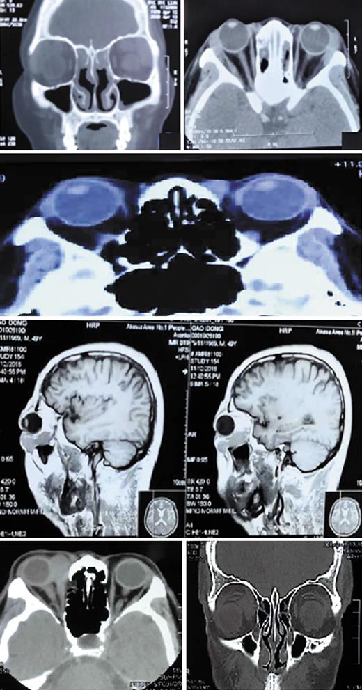 Fig. 2. Coronal CT of the orbit and mass shadow in the orbital lacrimal gland area in IgG4-ROD patients.