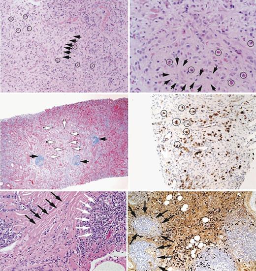 Fig. 3. Characteristics of tissue caseology in IgG4-ROD patients.