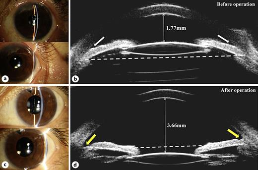 Ocular Characteristics of Pseudophakic Eyes with Malignant Glaucoma ...