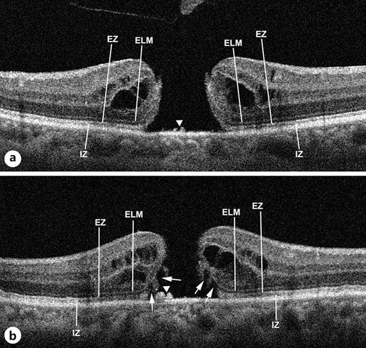 Photoreceptor Outer Segment Loss at the Macular Hole Border: Clinical ...