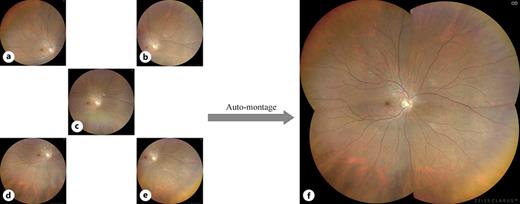 a–e Single images from central and four UWF directions (superior temporal, superior nasal, inferior temporal, and inferior nasal gazes). f Auto-montage image.