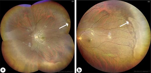 Differences in the montage angles may obscure some pathological changes, potentially resulting in missed lesions. Another example of missed opportunities for diagnoses using the Clarus 500™ includes an auto-montage image from the central and four UWF directions (superior temporal, superior nasal, inferior temporal, and inferior nasal gazes) (a); a single image from the middle temporal gaze, which was not mentioned in our research (b). The white arrow indicates the white without pressure.