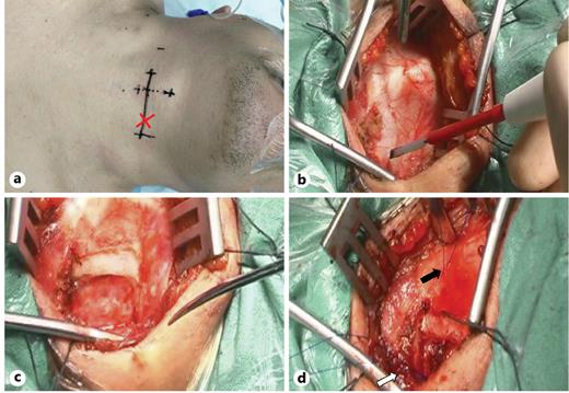 Fig. 1. Modified arytenoid adduction operation procedure for a representative case with UVFP. a Incision and the surface projection of arytenoid was shown. b Exposing the ipsilateral thyroid cartilage. c A window was created in the thyroid cartilage. d The position of sutures was shown. Black arrow: the fixation point of the laminae of thyroid cartilage; white arrow: the fixation point of the posterior cricoid ligament. UVFP, unilateral vocal fold paralysis.