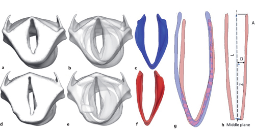 VF medialization from implant using one sample as an example. Model reconstructions in axial orientation with anterior at the bottom of the field and posterior at the top of the field. Reconstruction of the larynx at paramedian before implantation (a, b). Reconstruction of the VF cover layer at paramedian before implantation (c). Model reconstruction of the larynx after implantation (d, e). Model reconstruction of the VF cover layer after implantation (f). VF cover comparisons before and after implantation (g). Definitions of quantitative parameters to evaluate VF adduction (h).