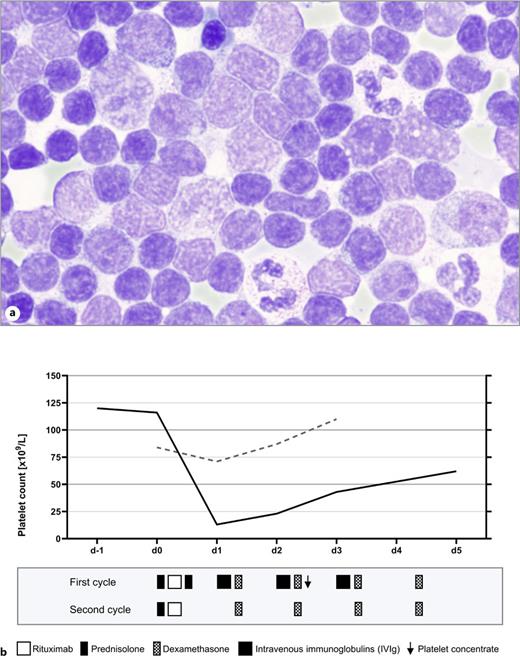 a Cytologic examination of high-grade bone marrow infiltration through lymphoma cells before salvage therapy. Pappenheim staining, original magnification, ×1,000. b Overview of platelet count dynamics during salvage therapy and corresponding therapeutic implications. The graph depicts the platelet count progression during the initial (continuous line) and the second cycle (dashed line) of salvage-therapy. Acute thrombocytopenia (AT) induced by anti-CD20 therapy was observed in the first cycle following rituximab administration. However, when rituximab was readministered in the second cycle, there was no recurrence of AT. The graph was created with GraphPad Prism (version 9.5.1).