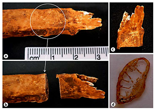 Fig. 1. a Sternal end of the 9th right rib of an adult female (Sk. 119, 64 years old) who died of bronchopneumonia. b Detail of the area sampled for analysis showing a slight round elevation (white arrow). c Rib section collected for histological analysis. d Detail of the bone sample after slide preparation, in which is visible an accumulation of bone on the visceral surface.