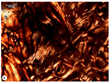 Fig. 6. a Microscopic view of the Sk. 54 right tibia sample showing the cortical tissue formed by osteons (white arrowheads) intersected, at some points by Volkmann's canals (black arrowheads). The periosteal surface was composed of a thin rim of bone (white asterisks). b Segment formed by osteons, intracortical lamellae (circle 1), and resorption spaces (circle 2). b1 Detail of the intracortical lamellae (or ‘Grenzstreifen'; black arrowheads) separating rows of osteons (white arrowheads). b2 Another magnification showing some resorption lacunae (or sinuous lacunae; white asterisk) in the intracortical lamellae (black arrowheads) and at the periosteal surface (white asterisk). Note the presence of osteons with enlarged Haversian canal (white arrowhead). c Segment showing a haphazard cortical microstructure formed by osteons (white arrowheads), interstitial lamellae (white asterisks), and compact intracortical lamellae (black arrowheads). d Thick layer of dense bone at the periosteal surface (black asterisks) connecting the cortical tissue formed by different sized osteons (white arrowheads). e Another segment revealing erratic osteons (white arrowheads) surrounded by elongated intracortical lamellae (black arrowheads). Polarized light. Magnification ×40; ×100.
