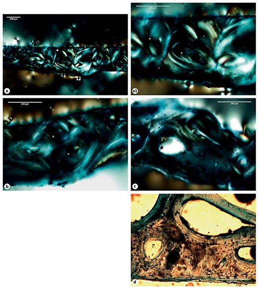 Fig. 7. a Micrograph of the right rib sample of the SK. 1,196 individual exhibiting the cortical tissue (circle 1). a1 Detail of the previous figure showing a thin row of osteons (white arrowheads) and interstitial lamellae (white asterisks). b Another segment revealing bays of bone resorption in the endosteal and periosteal surfaces (black arrowheads) and some intact cortical osteons (white arrowheads). c Segment showing a larger area of cortical (white asterisk) and endosteal (black arrowheads) bone resorption. d Illustration of a segment under plane light exhibiting a row of osteons (white arrowheads) with enlarged Haversian canals and numerous osteocyte lacunae. Polarized light. Magnification ×40; ×100.