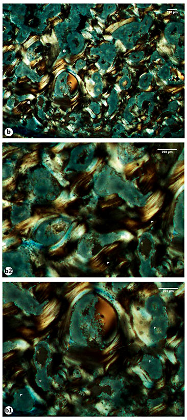 Fig. 9. a Microscopic view of the Sk. 198 right fibula callus showing the cortical tissue formed by a disorganized net of bone lamellae and remnants of ancient Haversian systems (circle 1 and 2). a1, a2 Details of the previous image showing large bays of bone resorption being formed after digestion of previous osteons (white arrowheads). b Another view highlighting numerous areas of bone resorption. b1 Magnification of the previous image revealing the large and irregular areas of bone resorption (white arrowheads). b2 Another magnification showing mature (white arrowheads) and more recently formed lamellae with osteocyte lacunae (black arrowheads). c Bone segment combining densely packed lamellae on the bone surface (black arrowheads) and branches of disorganized lamellae with osteocyte lacunae in the innermost areas of the cortical bone (white star). d Another view showing the outer surface composed of lamellae with a haphazard arrangement (white star) and pinpointed by numerous osteocyte lacunae. Polarized light. Magnification ×40; ×100.