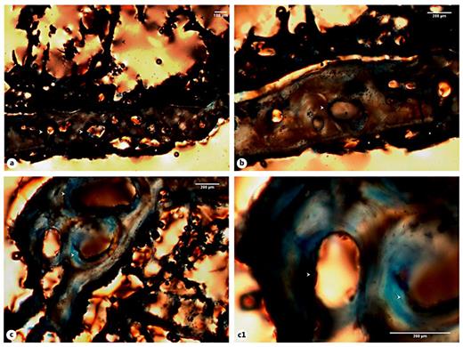 Fig. 10. a Micrograph of the Sk. 1,138 rib cortical tissue presenting mature osteons and enlarged Haversian canals (white arrowheads) and a deposit of new bone with an arc-like microanatomy at periosteal level (white asterisks). Note the presence of rib trabeculae and preserved blood vessels (black arrowheads). b Another view pinpointing a major area of osteonal bone resorption (white arrowheads) and the newly built bone (white asterisks). c, c1 Bone segments showing massive foci of osteon resorption (white arrowheads). Polarized light. Magnification ×40; ×100.