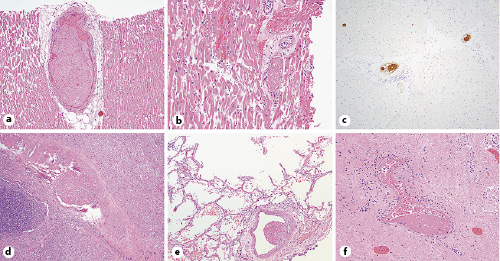 Fig. 1. Multisystem microscopic thromboses were common including in the intracardiac arteries and arterioles (a, b; ×20 and ×40), highlighted by CD61 immunohistochemistry (c; ×20), in the lung with (d; ×20) or without (e; ×20) associated infarction and in other organs including the prostate (f; ×40).