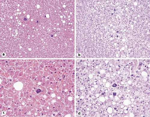 Fig. 2. Liver showing steatosis and large, atypical basophilic sinusoidal structures as seen in 2 separate cases. a H&E, ×20. b PAS-D, ×20. c H&E, ×40. d PAS-D, ×40.